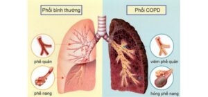 Cá thể hóa điều trị COPD