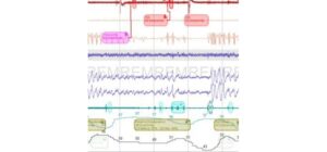 Phân tích kết quả đo giấc ngủ