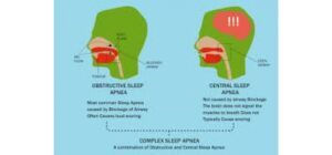 Phân biệt ngưng thở tắc nghẽn và ngưng thở trung ương