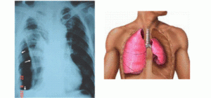 Di chứng lao phổi