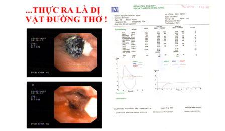 Dị vật đường thở chứ không phải hen