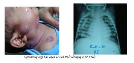 Một trường hợp lao hạch và lao phổi rất nặng ở trẻ 2 tuổi