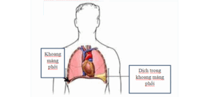 Nguyên nhân thường gặp của tràn dịch màng phổi