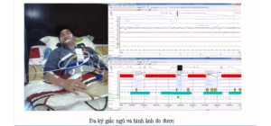 Bảng câu hỏi Berlin tầm soát ngưng thở khi ngủ