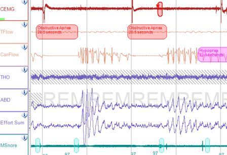 Kết quả đo giấc ngủ của bệnh nhân tại Phổi Việt