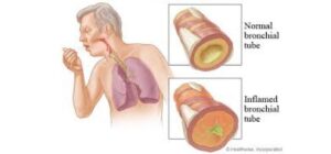 Làm cách nào để dễ ho khạc đờm ra ngoài?