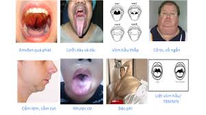 cấu tạo cơ thể gây hội chứng ngưng thở khi ngủ