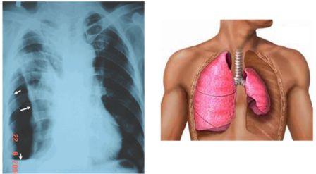 Tràn khí màng phổi