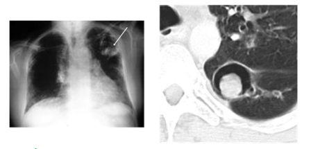 di chứng u nấm phổi sau lao