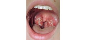 Viêm họng do liên cầu khuẩn (Streptoccocus)