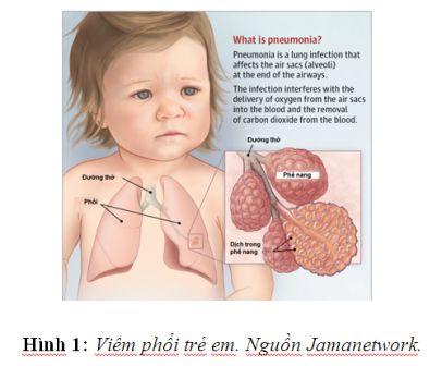 Viêm phổi ở trẻ em