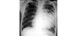 Viêm phổi cộng đồng