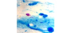 Hậu quả của việc điều trị lao không đúng và bỏ trị