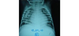 Lao sơ nhiễm ở trẻ em