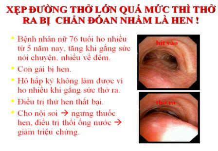 Xẹp đường thở lớn bị chẩn đoán nhầm là hen